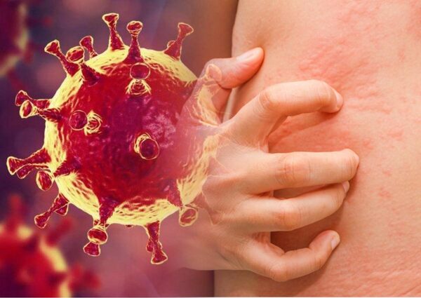Названы новые симптомы коронавируса, проявляющиеся на коже у молодых пациентов
