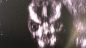 Нерожденный эмбрион с лицом Волан-де-Морта шокировал Сеть