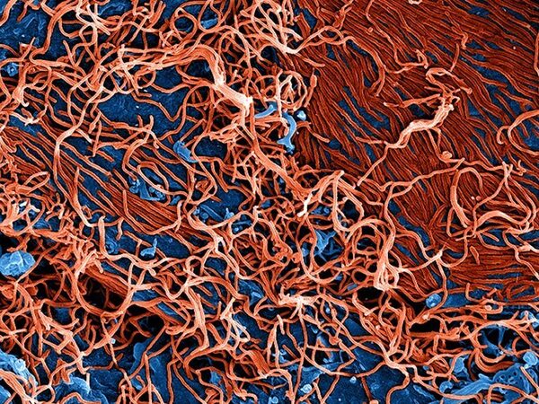 Вирус лихорадки Эбола поможет в борьбе с опухолями мозга