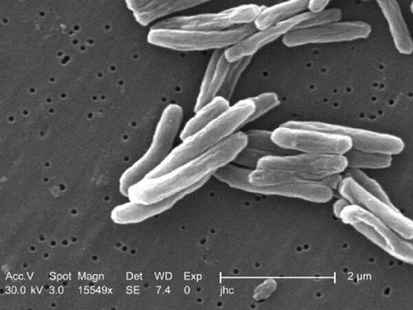 Новый метод позволит диагностировать туберкулез по выдыхаемому воздуху