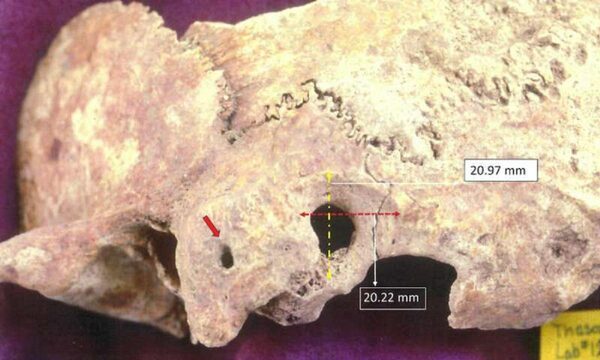 В Греции нашли древний череп со следами сложной операции на головном мозге