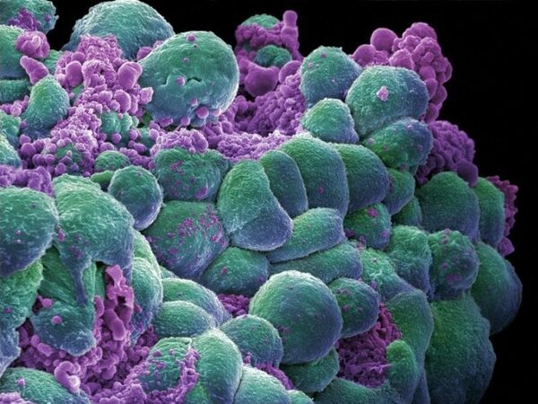 Инфракрасное излучение эффективно против редкого рака легких