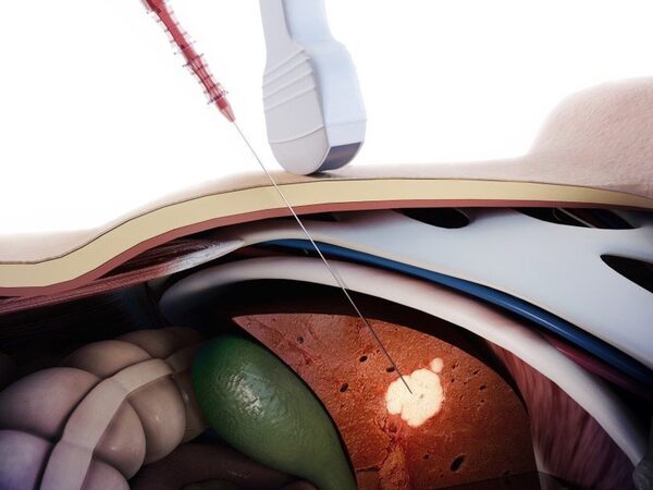 Метод оптической биопсии послужит для диагностики рака печени