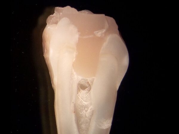 Новый стоматологический «клей» имитирует природную ткань зуба