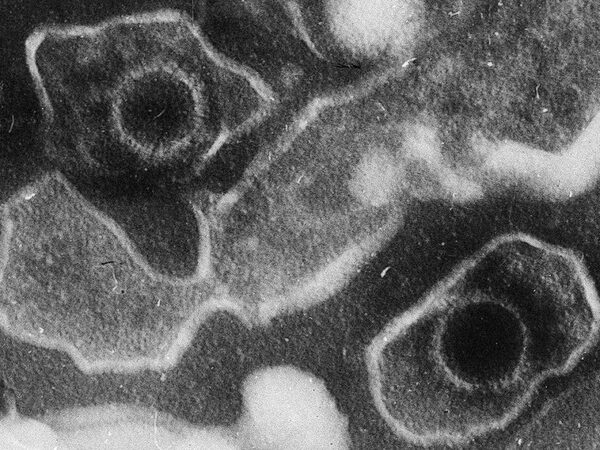 Возможным триггером рассеянного склероза назвали вирус Эпштейна — Барр