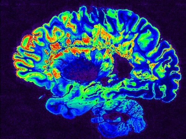 Неинвазивная электростимуляция мозга помогает улучшить память